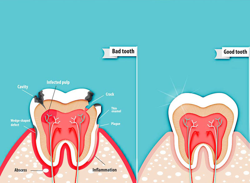 Pulpotomy.jpg Botulinum Toxin