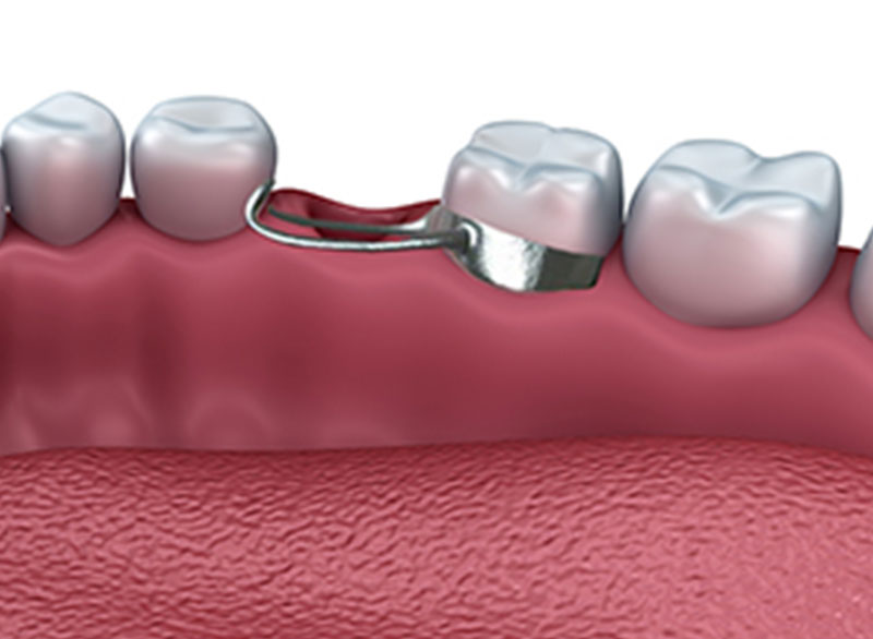 tooth-extraction.jpg Botulinum Toxin