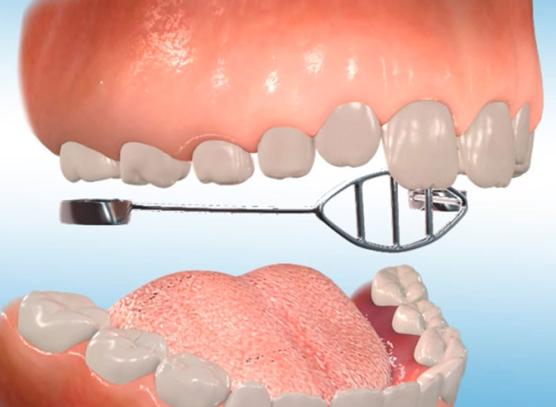 tooth-extraction.jpg Botulinum Toxin