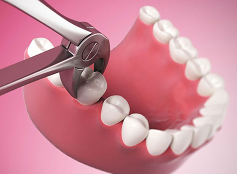 tooth-extraction.jpg Botulinum Toxin