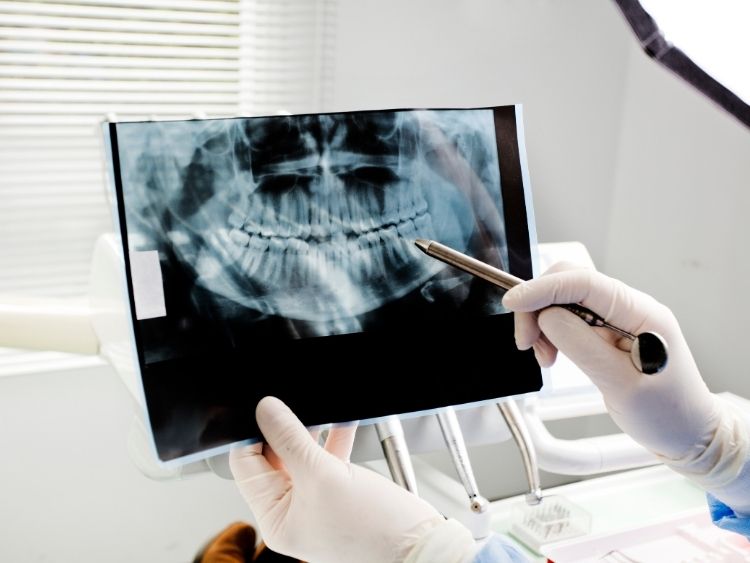 SmileMore Services (6) Botulinum Toxin