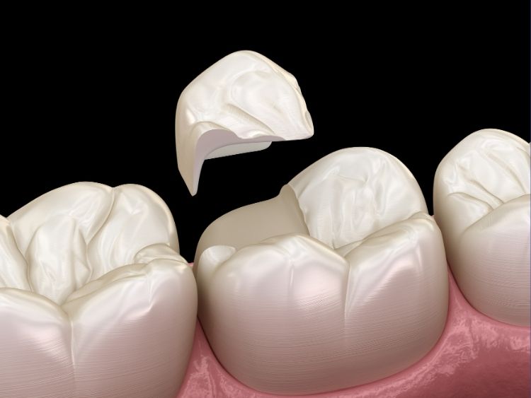 Advanced Tooth Repair (Inlays & Onlays) Advanced Tooth Repair (Inlays & Onlays)