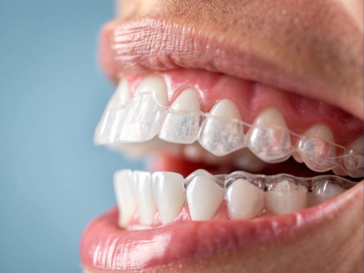 SmileMore Services (8) Advanced Tooth Repair (Inlays & Onlays)