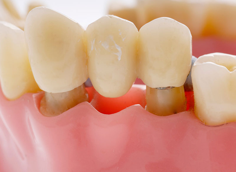 dental-bridge Botulinum Toxin