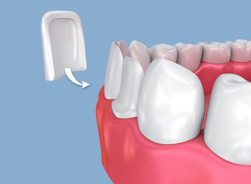 dental-crown Botulinum Toxin