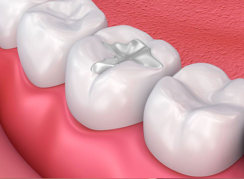dental-fillings Botulinum Toxin
