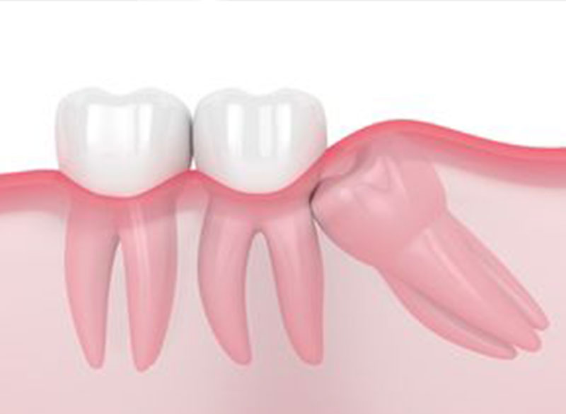 impaction Botulinum Toxin