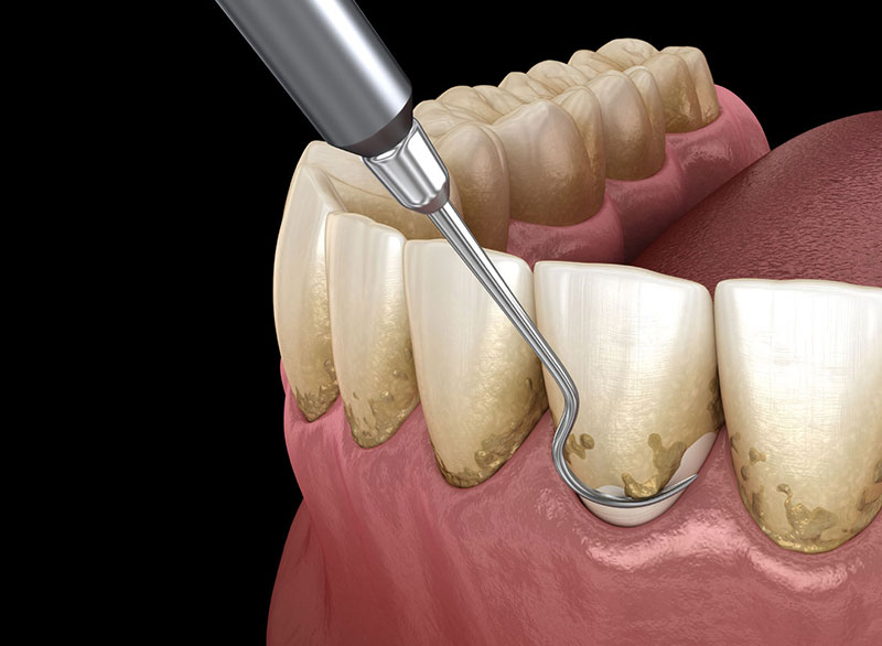 root-planing Botulinum Toxin
